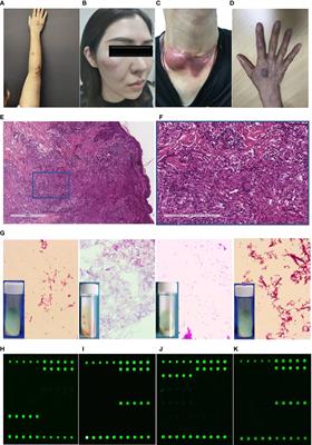 DNA microarray chip assay in new use: early diagnostic value in cutaneous mycobacterial infection